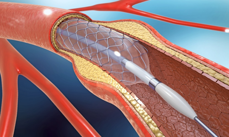 Nên đặt stent graft khi nào, tác dụng ra sao? 3