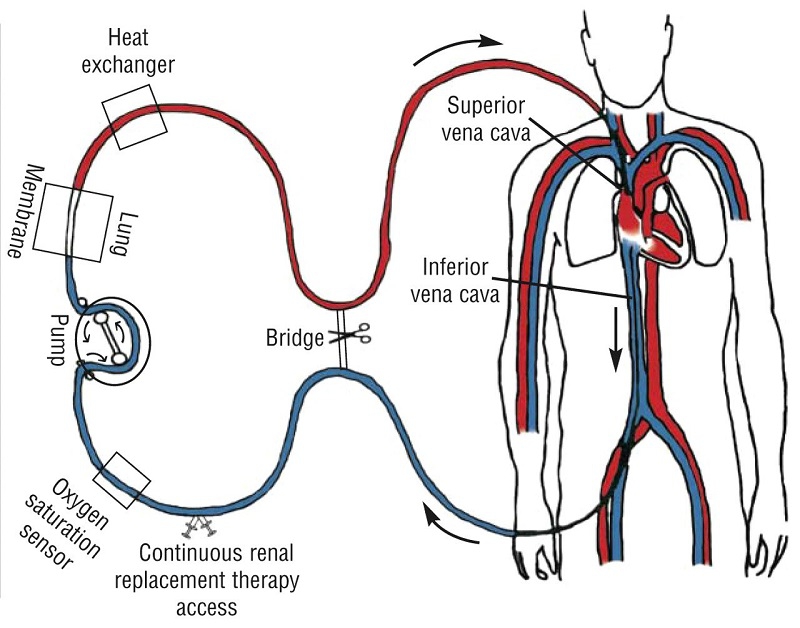 Máy ECMO có tác dụng gì? 2