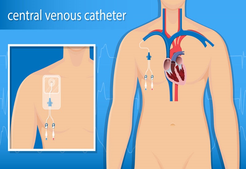 Những điều cần biết về phương pháp đặt catheter tĩnh mạch trung ương 2