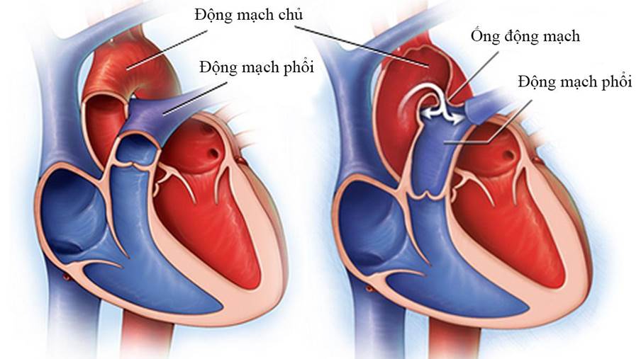 PDA là bệnh gì? Tìm hiểu nguyên nhân, triệu chứng và cách điều trị hiệu quả