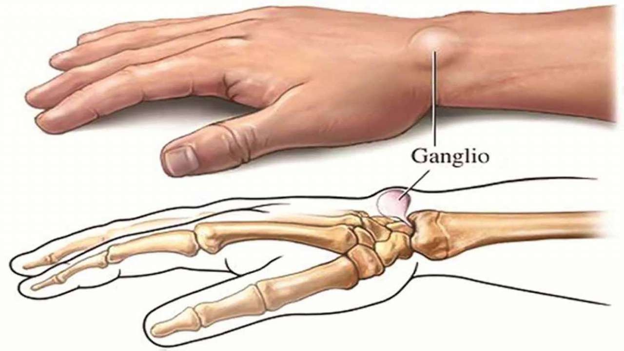 Có những biện pháp phòng ngừa nào để giảm nguy cơ mắc ung thư xương chân?