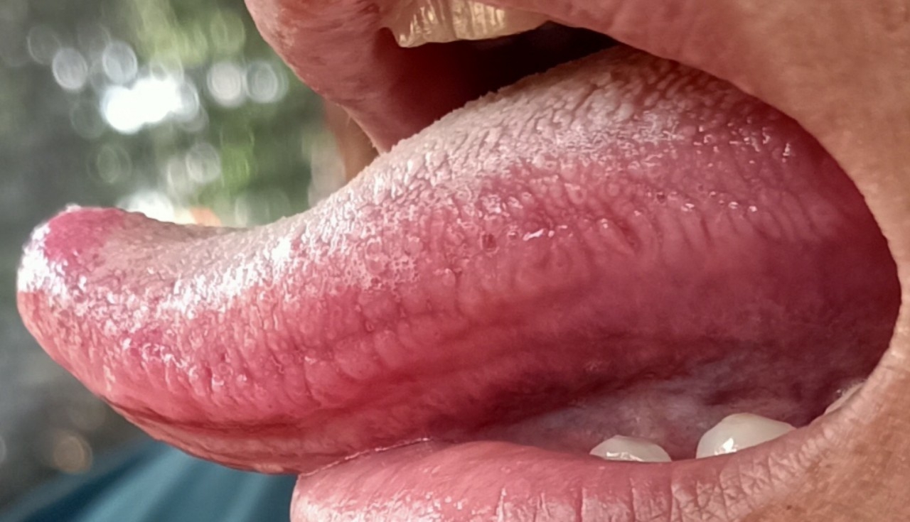 Tưa miệng: Khoang miệng bị nhiễm nấm Candida albicans