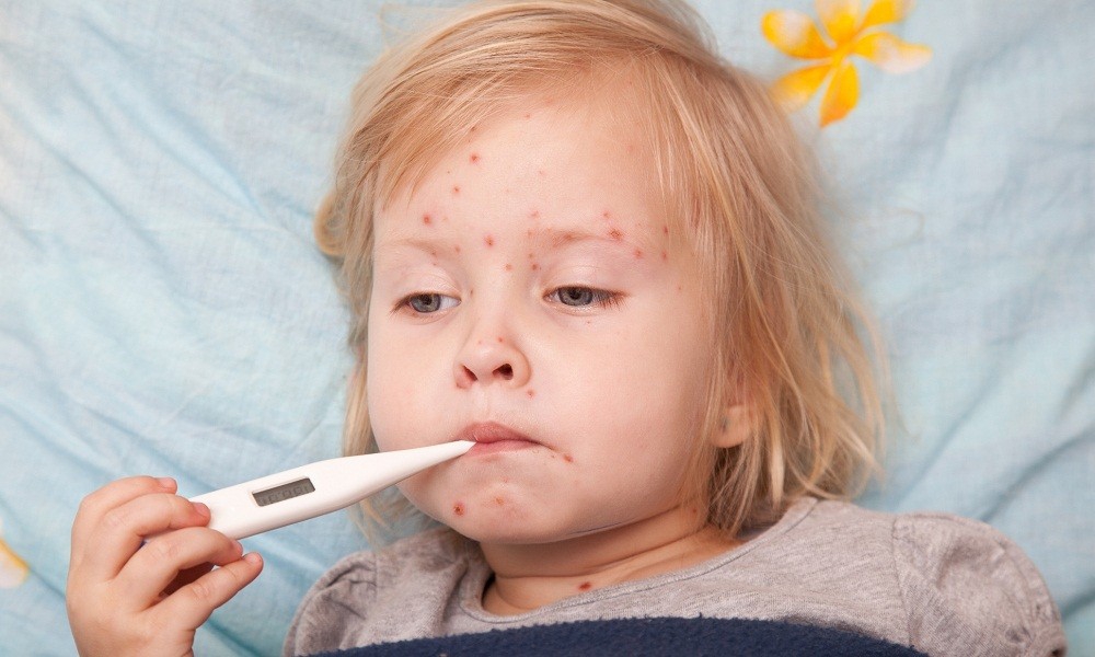 Bệnh zona ở trẻ em có triệu chứng gì?

