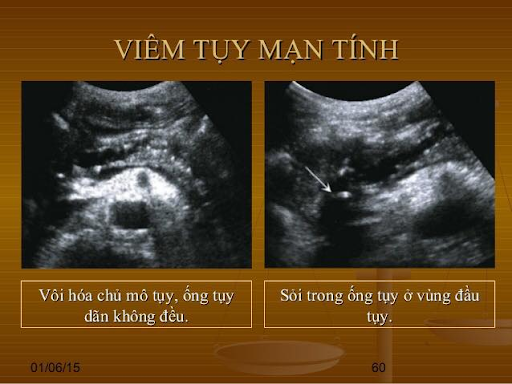 Viêm tụy mạn: Nguyên nhân, triệu chứng và điều trị bệnh