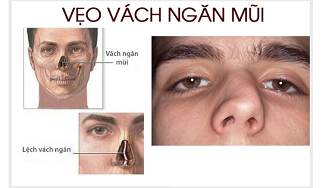 Vẹo vách ngăn mũi: Nguyên nhân, triệu chứng và cách điều trị