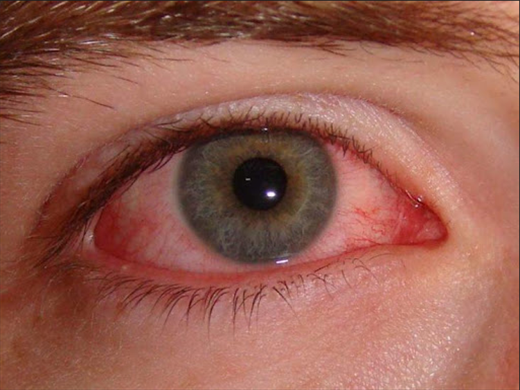 Những điều cần lưu ý khi điều trị bệnh đau mắt đỏ?
