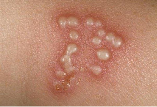 Bệnh Herpes Simplex: Triệu Chứng, Nguyên Nhân và Cách Phòng Ngừa Hiệu Quả