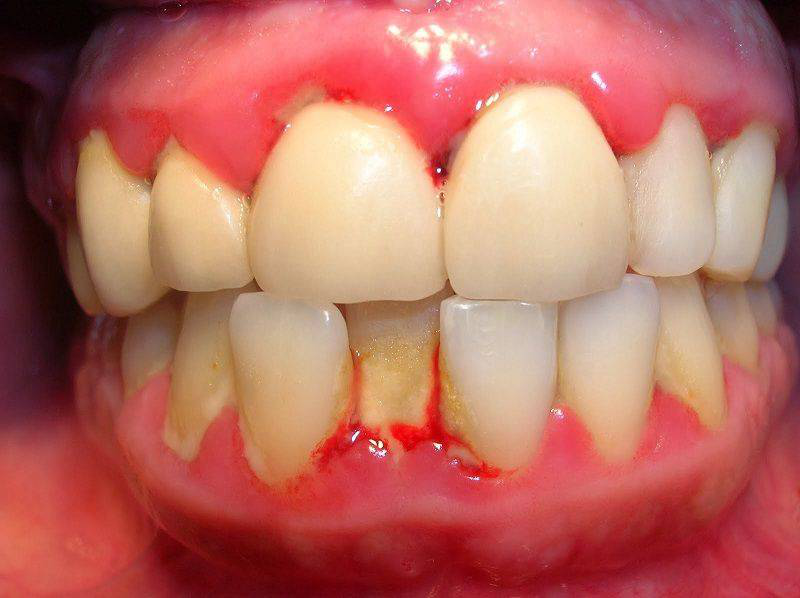 U răng ở hàm có thể gây ra những biến chứng nào?
