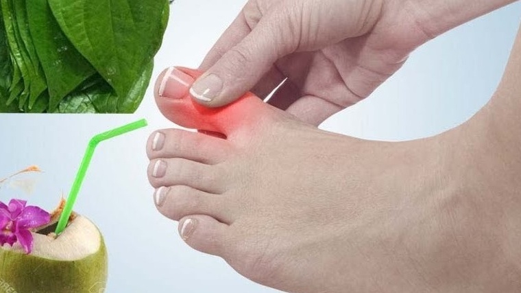 Chữa bệnh gout bằng lá trầu và nước dừa đơn giản mà bạn có thể tham khảo