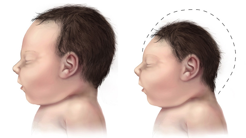8 nguyên nhân gây tật đầu nhỏ ở trẻ và cách kiểm soát bệnh