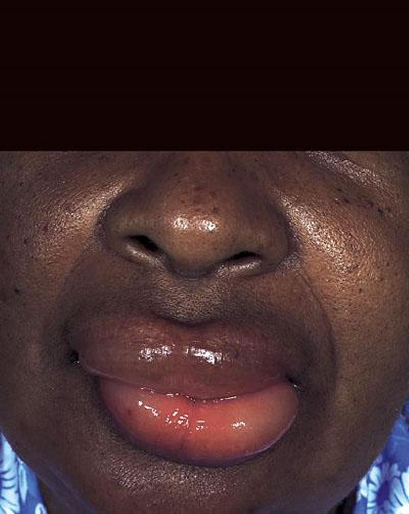 Sưng môi có liên quan đến bệnh phù mạch không?
