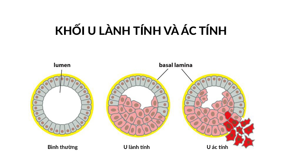 Âm tính giả trong kết quả sinh thiết có nghĩa là gì?