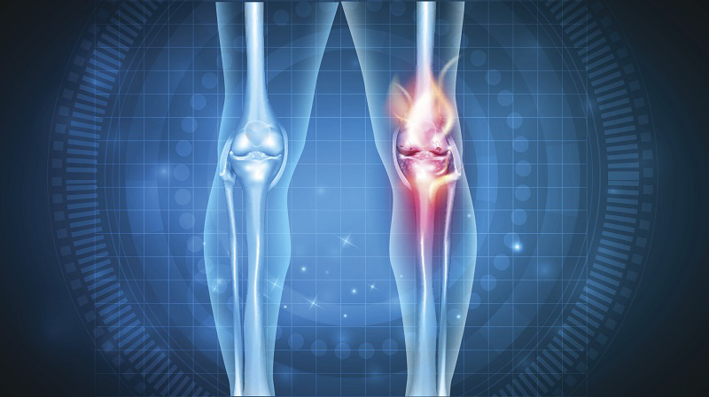 Arthritis là gì? Phòng tránh và điều trị 2