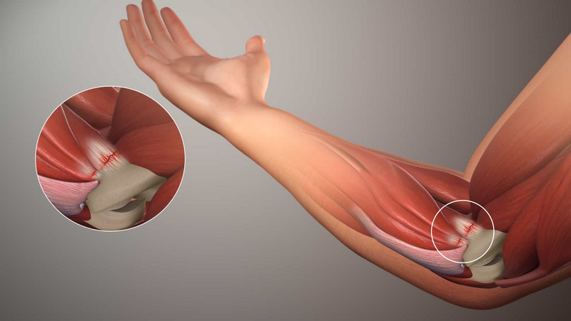 Bong gân khuỷu tay: Dấu hiệu nhận biết và hướng điều trị hiệu quả 2