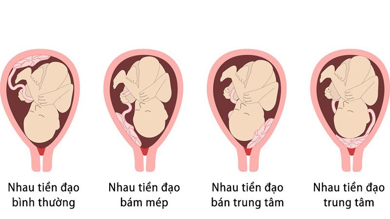 Bánh nhau thai là gì và 5 bệnh lý bánh nhau thường gặp