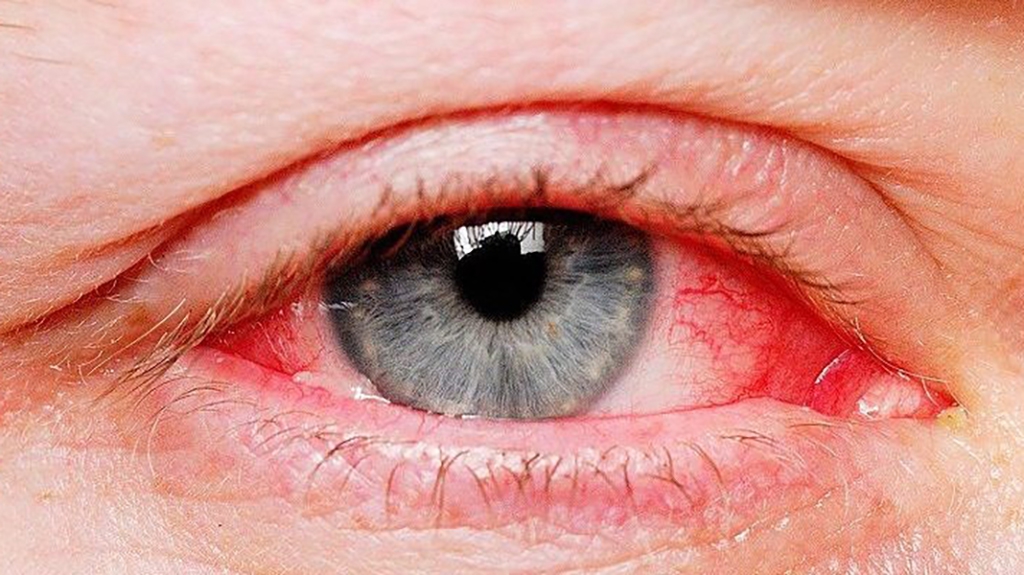Cẩn trọng với bệnh viêm kết mạc do virus gây ra