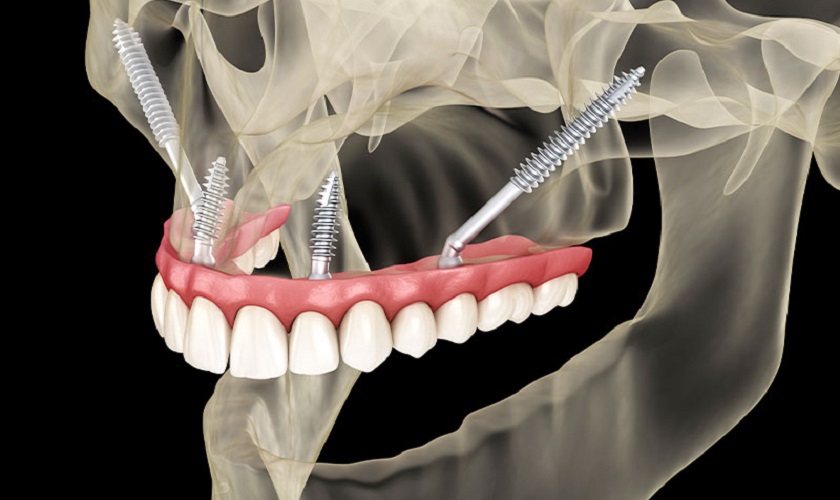 Cấy ghép Zygoma Implant có an toàn không?