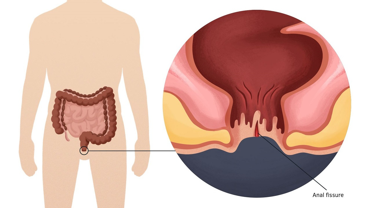 Chảy Máu Hậu Môn Nhưng Không Đau: Nguyên Nhân, Triệu Chứng và Giải Pháp