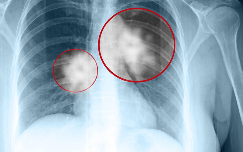 Chụp X quang có ảnh hưởng gì không? 3