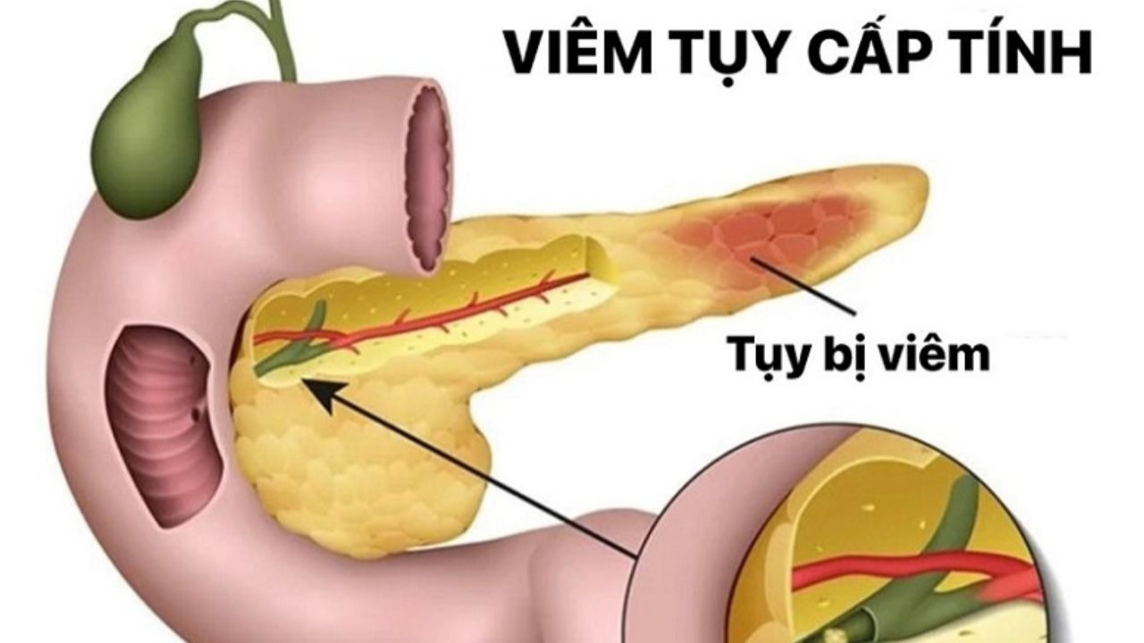 Những đặc điểm đau do viêm tụy cấp có thể bạn chưa biết