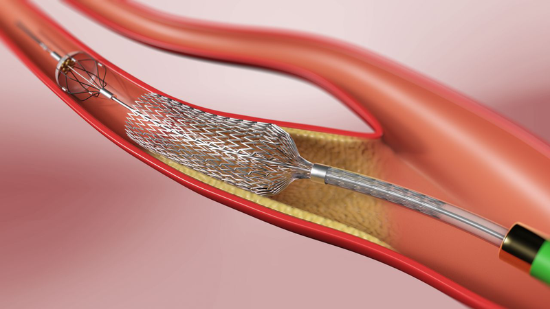 Đặt stent niệu quản là gì? Giải thích chi tiết 1