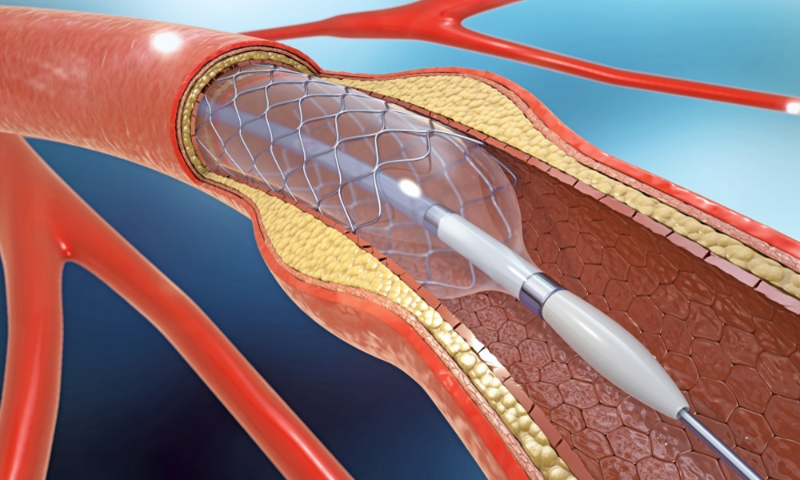 Đặt stent niệu quản là gì? Giải thích chi tiết 3