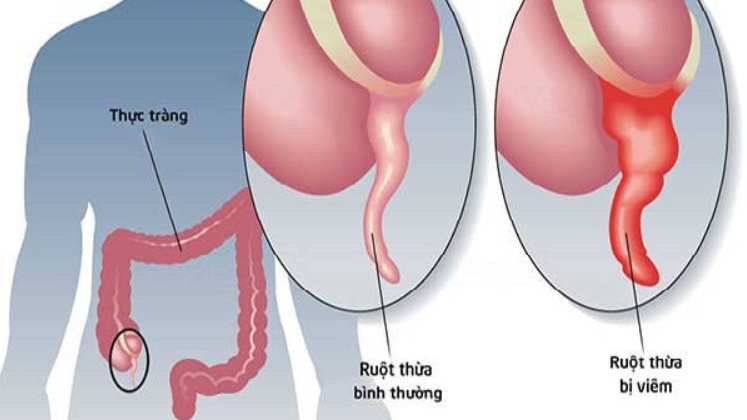 Dấu blumberg trong chẩn đoán bệnh đường tiêu hóa