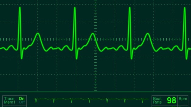 Điện tâm đồ gắng sức là gì? Quy trình thực hiện điện tâm đồ gắng sức như thế nào?