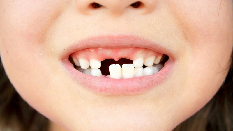 Điều trị và phòng ngừa sún răng sớm ở trẻ nhỏ 1