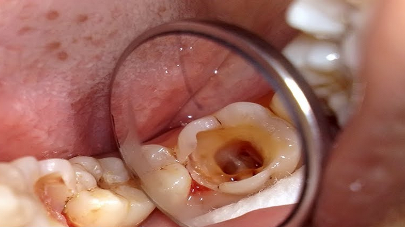 Điều trị viêm quanh cuống răng 1