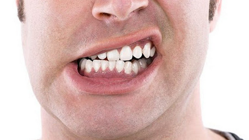 Điều trị viêm quanh cuống răng 2