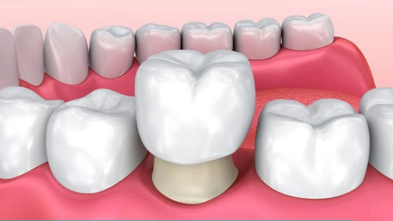 Điều trị viêm quanh cuống răng 3
