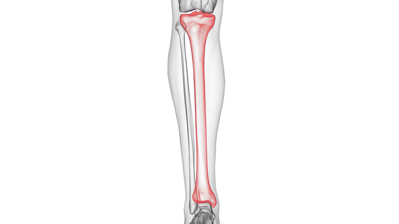 Gãy 1/3 dưới xương chày: Nguyên nhân, dấu hiệu và cách điều trị