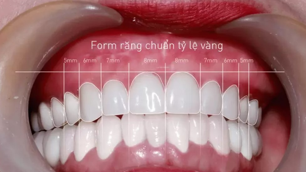 Tiêu chuẩn của một hàm răng đẹp là thế nào? Cách để có được hàm răng trắng đẹp