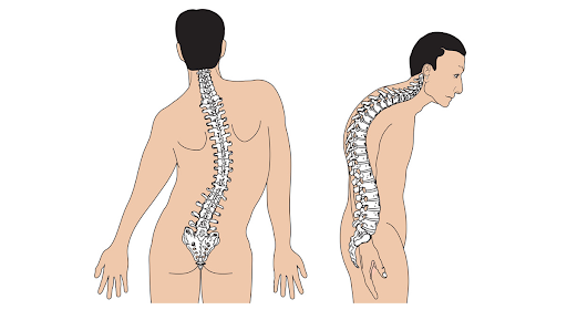 Nguyên nhân và hậu quả của cong vẹo cột sống