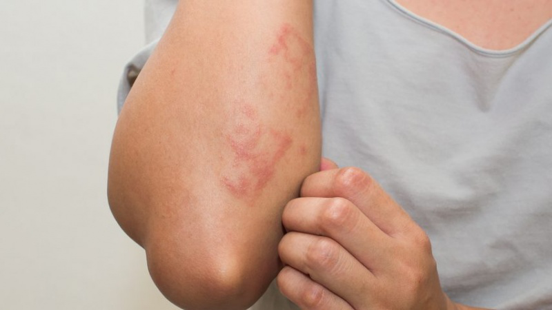 Hội chứng hồng ban nút (erythema nodosum) 2