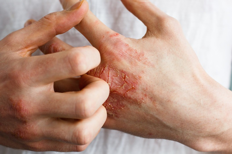 Hội chứng hồng ban nút (erythema nodosum) 5