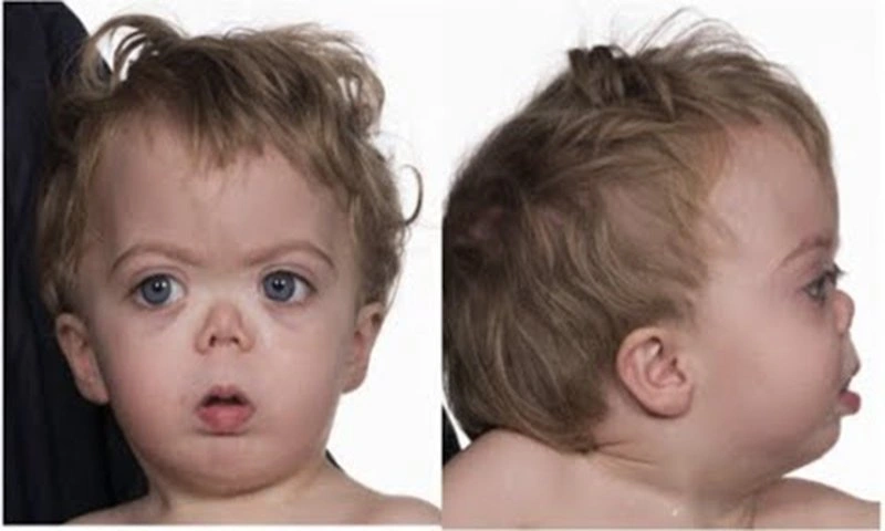 Hội chứng thiên thần (Angelman syndrome)