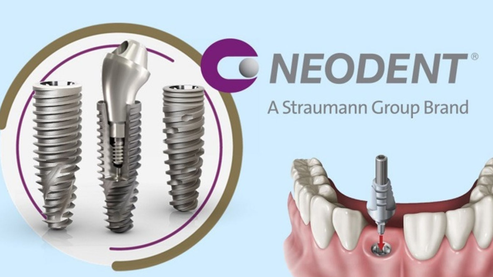 Tìm hiểu về đặc điểm và lợi ích khi cấy Implant Neodent