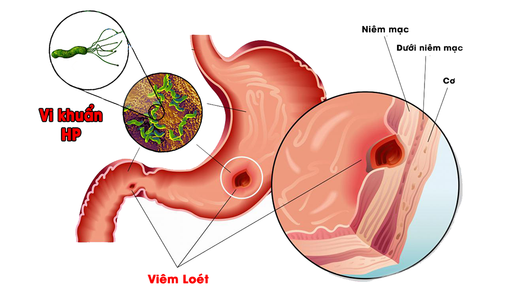 Giá Xét Nghiệm Máu HP