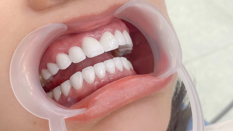 Kinh nghiệm chăm sóc răng sứ an toàn sau khi bọc 1