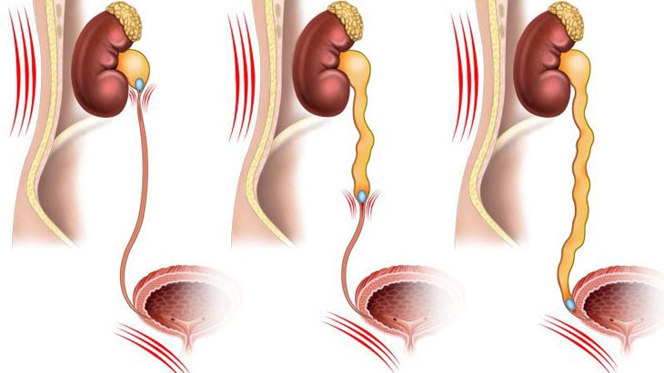 Chụp Kub là gì? Mối liên hệ giữa chụp Kub và bệnh sỏi niệu quản