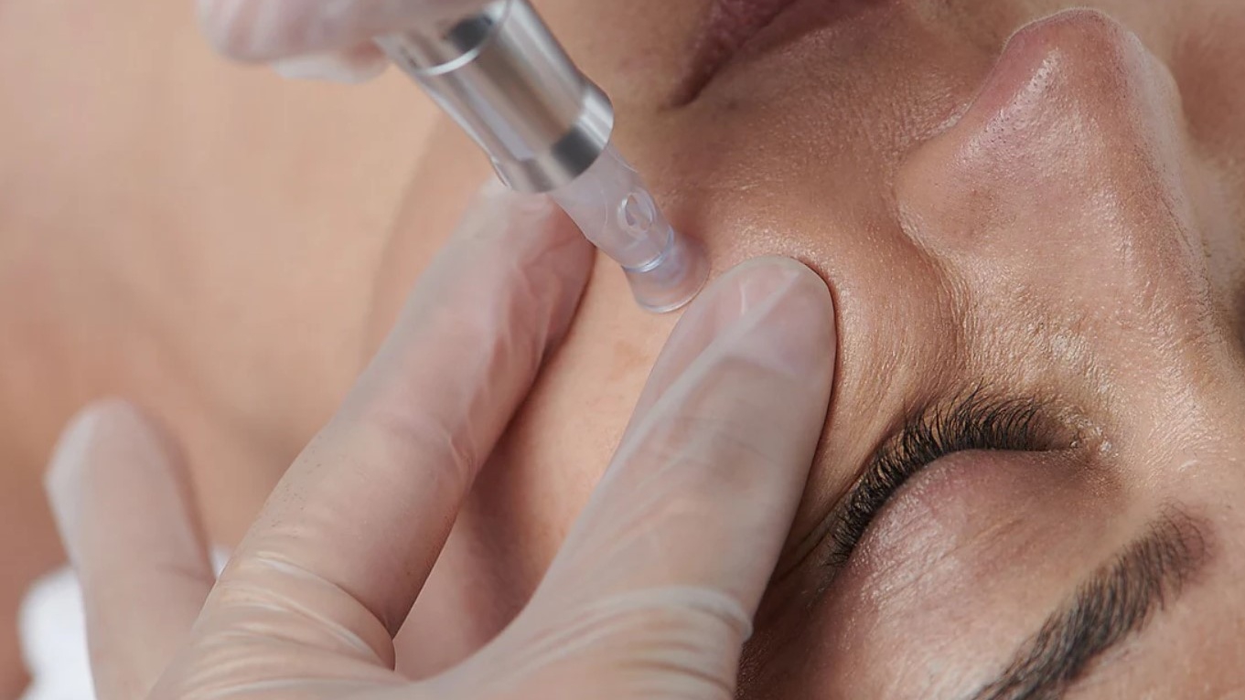 So sánh microneedling và microdermabrasion