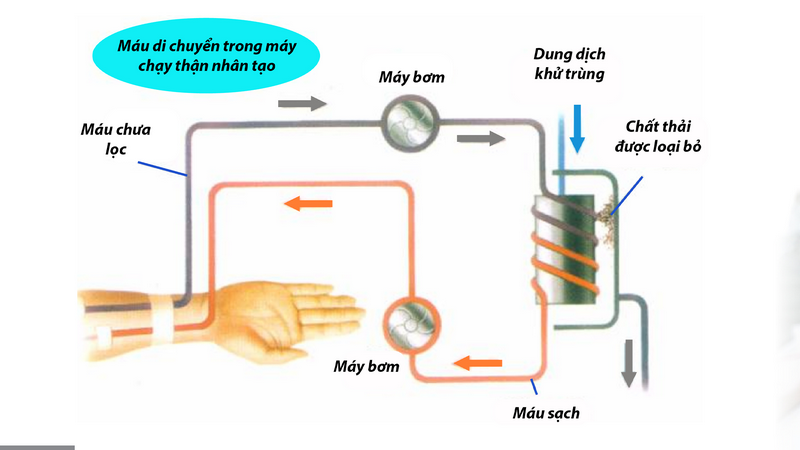 Nhận biết biến chứng của suy thận mạn giai đoạn cuối và cách điều trị 4