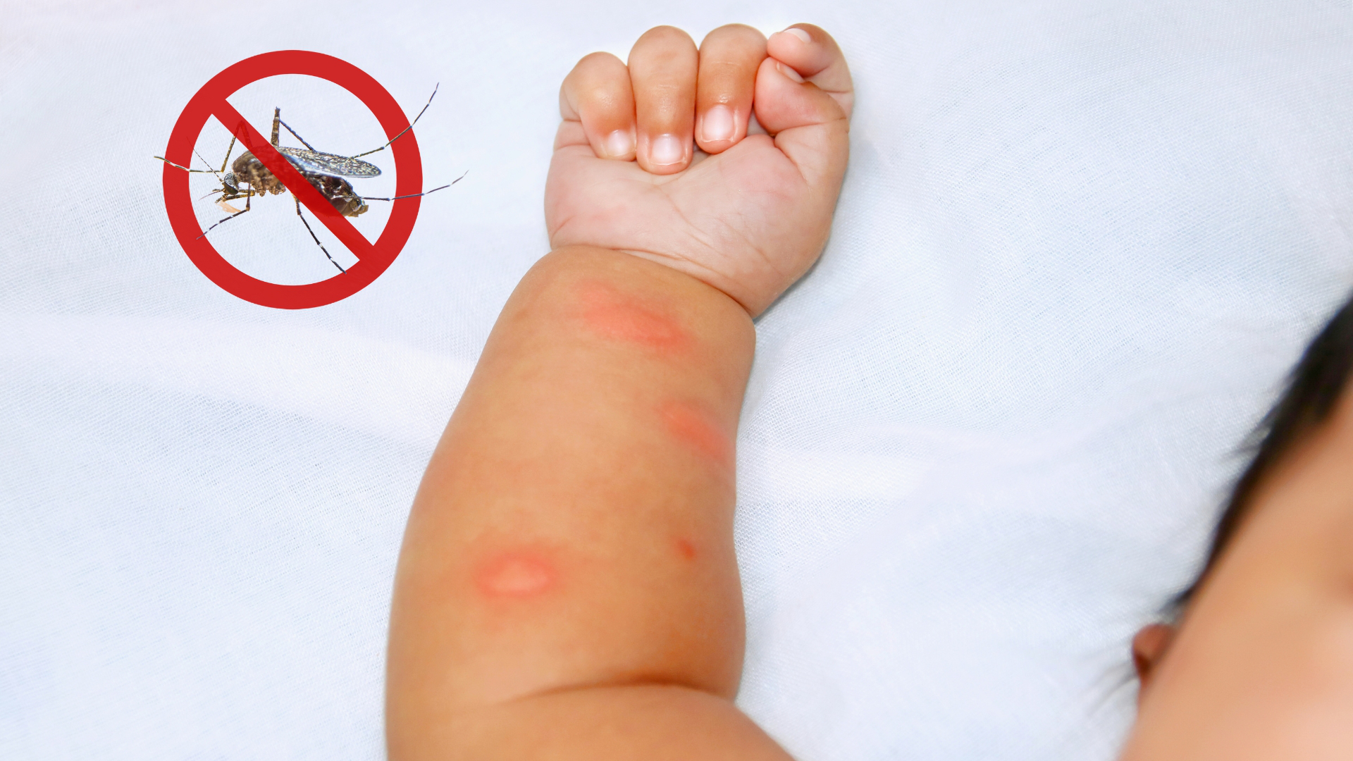 Hình ảnh sốt xuất huyết ở trẻ em: Nhận biết và cách điều trị