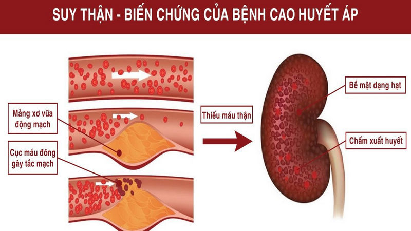 Nhận biết sớm đợt cấp suy thận mạn và cách điều trị 3