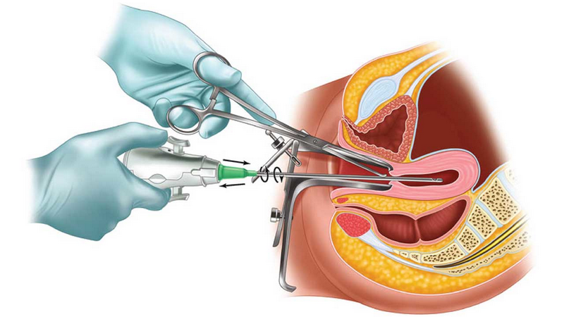 Những hậu quả đáng sợ khi lạm dụng hút điều hòa kinh nguyệt 1