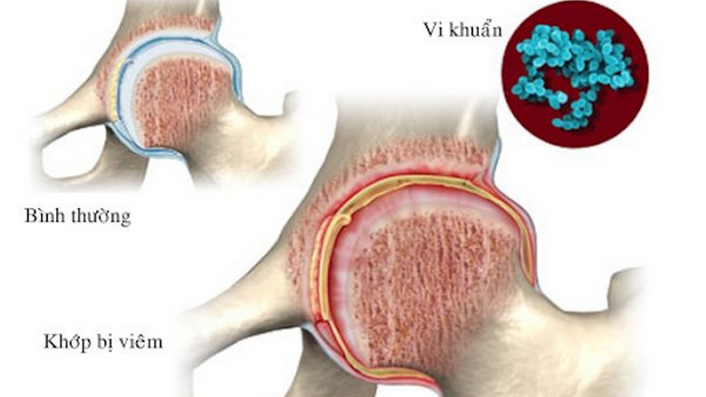 Phương pháp chẩn đoán và phác đồ điều trị viêm khớp nhiễm trùng