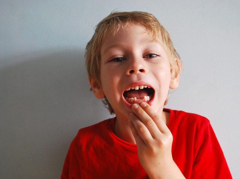 Răng mọc lệch: Nguyên nhân và giải pháp hiệu quả 3