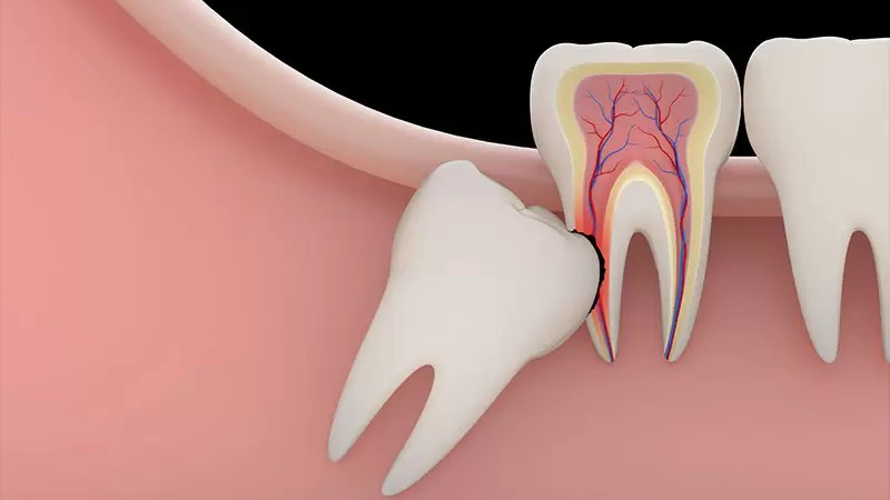 Răng số 8 mọc lệch có nguy hiểm không? 2